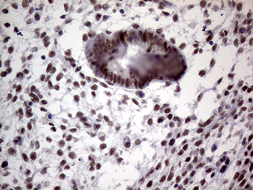 TLK2 Antibody - Immunohistochemical staining of paraffin-embedded Human endometrium tissue within the normal limits using anti-TLK2 mouse monoclonal antibody. (Heat-induced epitope retrieval by 1mM EDTA in 10mM Tris buffer. (pH8.5) at 120°C for 3 min. (1:500)