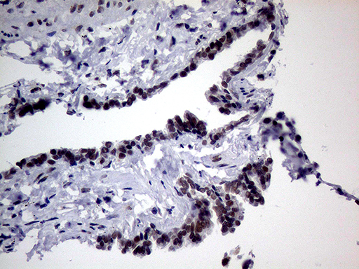 TLK2 Antibody - Immunohistochemical staining of paraffin-embedded Human lung tissue within the normal limits using anti-TLK2 mouse monoclonal antibody. (Heat-induced epitope retrieval by 1mM EDTA in 10mM Tris buffer. (pH8.5) at 120°C for 3 min. (1:500)