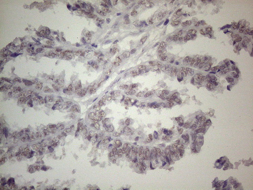 TLK2 Antibody - Immunohistochemical staining of paraffin-embedded Adenocarcinoma of Human ovary tissue using anti-TLK2 mouse monoclonal antibody. (Heat-induced epitope retrieval by 1mM EDTA in 10mM Tris buffer. (pH8.5) at 120°C for 3 min. (1:150)