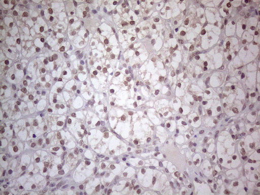 TLK2 Antibody - Immunohistochemical staining of paraffin-embedded Carcinoma of Human kidney tissue using anti-TLK2 mouse monoclonal antibody. (Heat-induced epitope retrieval by 1mM EDTA in 10mM Tris buffer. (pH8.5) at 120°C for 3 min. (1:150)