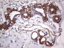 TLK2 Antibody - Immunohistochemical staining of paraffin-embedded Adenocarcinoma of Human breast tissue using anti-TLK2 mouse monoclonal antibody. (Heat-induced epitope retrieval by 1 mM EDTA in 10mM Tris, pH8.5, 120C for 3min,
