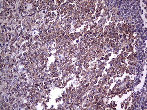 TLK2 Antibody - Immunohistochemical staining of paraffin-embedded Human tonsil within the normal limits using anti-TLK2 mouse monoclonal antibody. (Heat-induced epitope retrieval by 1 mM EDTA in 10mM Tris, pH8.5, 120C for 3min,