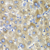 TLK2 Antibody - Immunohistochemistry of paraffin-embedded human liver injury tissue.