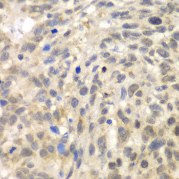 TLK2 Antibody - Immunohistochemistry of paraffin-embedded human esophageal cancer tissue.