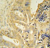 TLL1 Antibody - TLL1 antibody immunohistochemistry of formalin-fixed and paraffin-embedded human prostate carcinoma followed by peroxidase-conjugated secondary antibody and DAB staining.