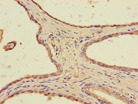 TLL1 Antibody - Immunohistochemistry of paraffin-embedded human prostate cancer tissue using TLL1 Antibody at dilution of 1:100