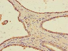 TLL1 Antibody - Immunohistochemistry of paraffin-embedded human prostate cancer tissue using TLL1 Antibody at dilution of 1:100