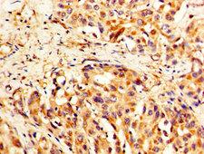TLN1 / Talin 1 Antibody - IHC image of TLN1 Antibody diluted at 1:400 and staining in paraffin-embedded human liver cancer performed on a Leica BondTM system. After dewaxing and hydration, antigen retrieval was mediated by high pressure in a citrate buffer (pH 6.0). Section was blocked with 10% normal goat serum 30min at RT. Then primary antibody (1% BSA) was incubated at 4°C overnight. The primary is detected by a biotinylated secondary antibody and visualized using an HRP conjugated SP system.