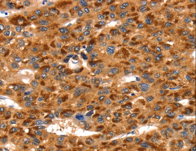 TLN1 / Talin 1 Antibody - Immunohistochemistry of paraffin-embedded Human liver cancer using TLN1 Polyclonal Antibody at dilution of 1:35.