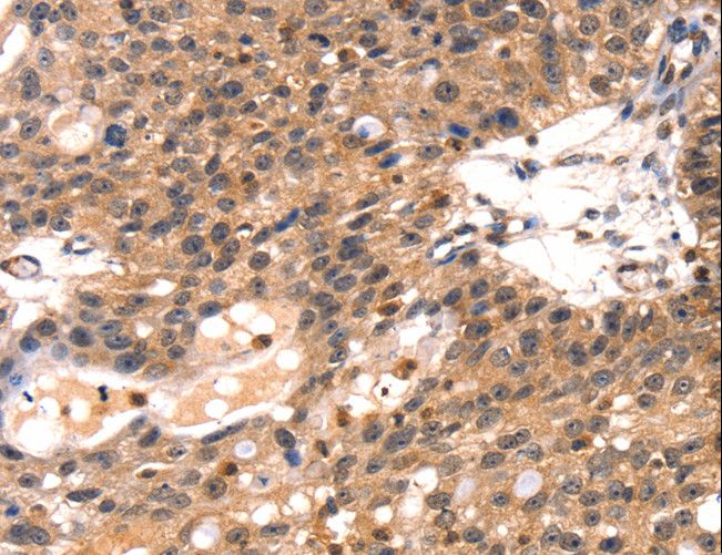 TLN1 / Talin 1 Antibody - Immunohistochemistry of paraffin-embedded Human breast cancer using TLN1 Polyclonal Antibody at dilution of 1:35.