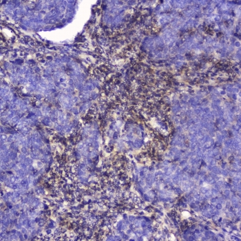TLN1 / Talin 1 Antibody - IHC testing of FFPE human lung cancer with Talin 1 antibody at 2ug/ml. HIER: boil tissue sections in pH6, 10mM citrate buffer, for 10-20 min followed by cooling at RT for 20 min.