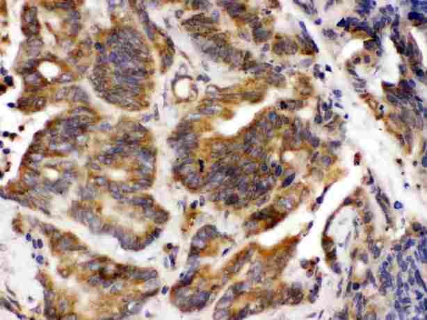 TLN2 / Talin 2 Antibody - Talin 2 was detected in paraffin-embedded sections of human intestinal cancer tissues using rabbit anti- Talin 2 Antigen Affinity purified polyclonal antibody