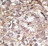 TLR1 Antibody - Formalin-fixed and paraffin-embedded human cancer tissue reacted with the primary antibody, which was peroxidase-conjugated to the secondary antibody, followed by AEC staining. This data demonstrates the use of this antibody for immunohistochemistry; clinical relevance has not been evaluated. BC = breast carcinoma; HC = hepatocarcinoma.