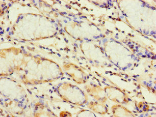 TLR1 Antibody - Immunohistochemistry of paraffin-embedded human gastric cancer at dilution of 1:100