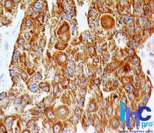 TLR2 Antibody - Immunohistochemistry-Paraffin: TLR2 Antibody (67N8F8) - Formalin-fixed, paraffin-embedded human esophageal squamous cell carcinoma stained with TLR2 antibody at 5 ug/ml.  This image was taken for the unconjugated form of this product. Other forms have not been tested.