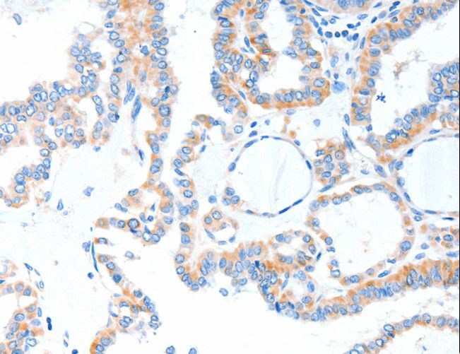 TLR2 Antibody - Immunohistochemistry of paraffin-embedded Human thyroid cancer using TLR2 Polyclonal Antibody at dilution of 1:55.