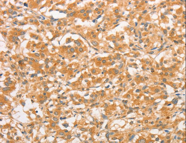 TLR3 Antibody - Immunohistochemistry of paraffin-embedded Human gastric cancer using TLR3 Polyclonal Antibody at dilution of 1:50.