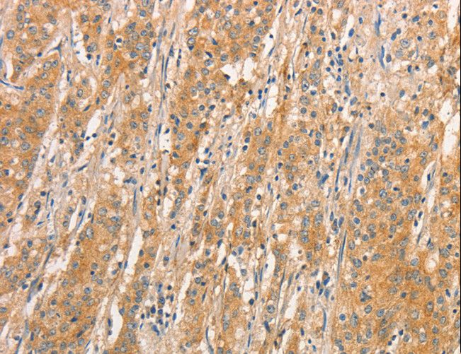 TLR3 Antibody - Immunohistochemistry of paraffin-embedded Human gastric cancer using TLR3 Polyclonal Antibody at dilution of 1:50.