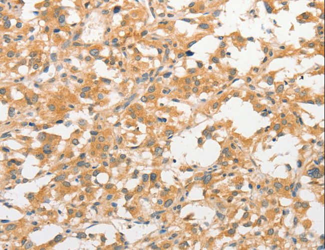 TLR3 Antibody - Immunohistochemistry of paraffin-embedded Human liver cancer using TLR3 Polyclonal Antibody at dilution of 1:40.