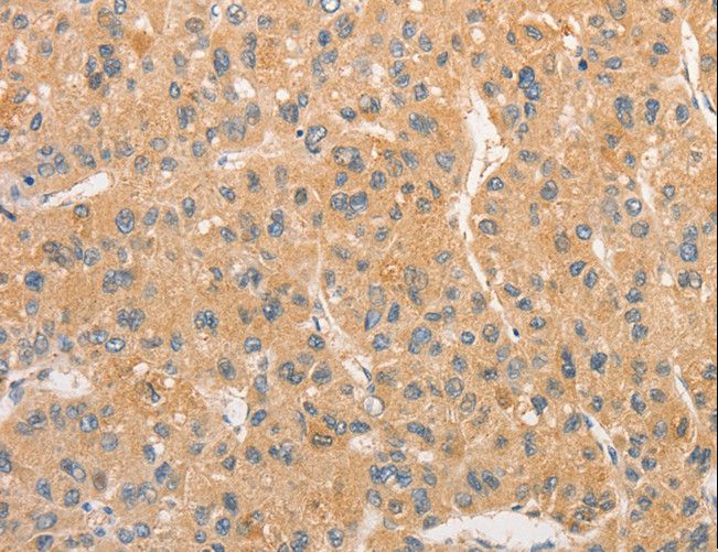 TLR3 Antibody - Immunohistochemistry of paraffin-embedded Human liver cancer using TLR3 Polyclonal Antibody at dilution of 1:40.