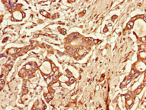 TLR3 Antibody - Immunohistochemistry of paraffin-embedded human pancreatic cancer using TLR3 Antibody at dilution of 1:100