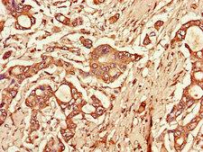 TLR3 Antibody - Immunohistochemistry of paraffin-embedded human pancreatic cancer using TLR3 Antibody at dilution of 1:100