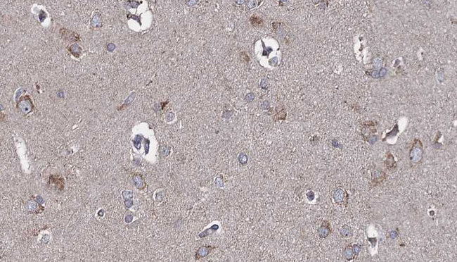 TLR3 Antibody - 1:100 staining human brain carcinoma tissue by IHC-P. The sample was formaldehyde fixed and a heat mediated antigen retrieval step in citrate buffer was performed. The sample was then blocked and incubated with the antibody for 1.5 hours at 22°C. An HRP conjugated goat anti-rabbit antibody was used as the secondary.