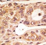 TLR5 Antibody - Formalin-fixed and paraffin-embedded human cancer tissue reacted with the primary antibody, which was peroxidase-conjugated to the secondary antibody, followed by AEC staining. This data demonstrates the use of this antibody for immunohistochemistry; clinical relevance has not been evaluated. BC = breast carcinoma; HC = hepatocarcinoma.