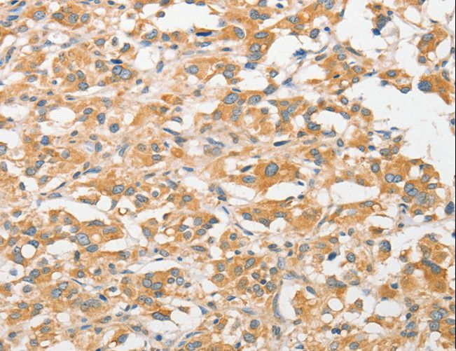 TLR5 Antibody - Immunohistochemistry of paraffin-embedded Human liver cancer using TLR5 Polyclonal Antibody at dilution of 1:30.