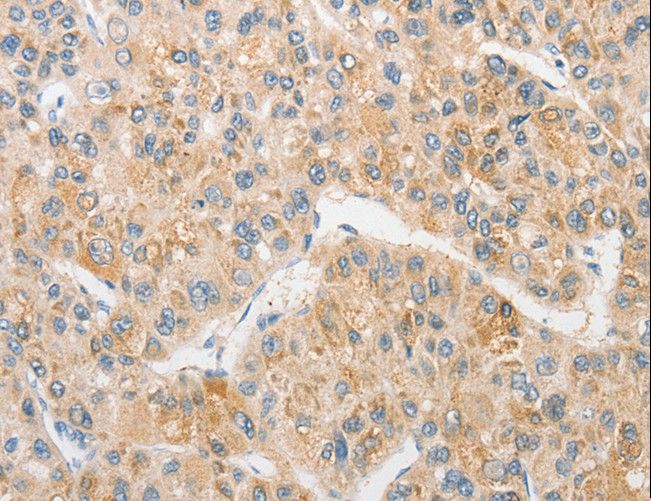TLR5 Antibody - Immunohistochemistry of paraffin-embedded Human liver cancer using TLR5 Polyclonal Antibody at dilution of 1:30.