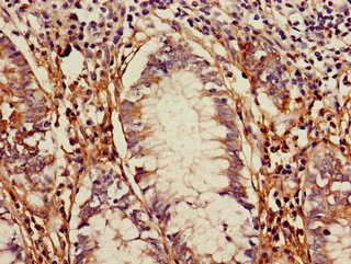 TLR5 Antibody - Immunohistochemistry of paraffin-embedded human colon cancer using TLR5 Antibody at dilution of 1:100