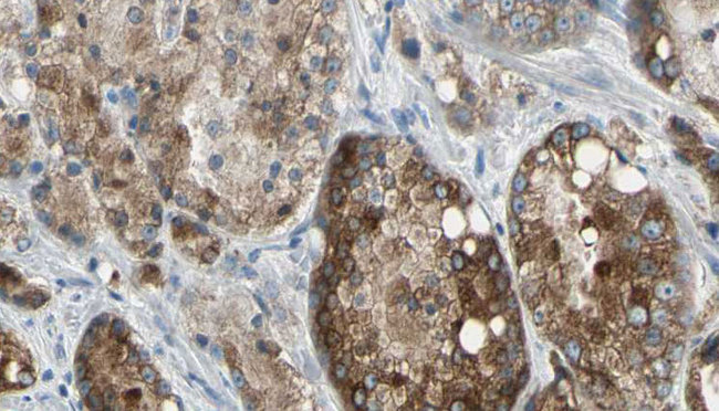 TLR5 Antibody - 1:100 staining human prostate tissue by IHC-P. The sample was formaldehyde fixed and a heat mediated antigen retrieval step in citrate buffer was performed. The sample was then blocked and incubated with the antibody for 1.5 hours at 22°C. An HRP conjugated goat anti-rabbit antibody was used as the secondary.