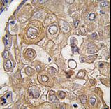 TLR6 Antibody - Formalin-fixed and paraffin-embedded human lung carcinoma tissue reacted with TLR6 antibody , which was peroxidase-conjugated to the secondary antibody, followed by DAB staining. This data demonstrates the use of this antibody for immunohistochemistry; clinical relevance has not been evaluated.