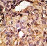 TLR6 Antibody - Formalin-fixed and paraffin-embedded human cancer tissue reacted with the primary antibody, which was peroxidase-conjugated to the secondary antibody, followed by AEC staining. This data demonstrates the use of this antibody for immunohistochemistry; clinical relevance has not been evaluated. BC = breast carcinoma; HC = hepatocarcinoma.
