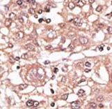 TLR7 / CD287 Antibody - Formalin-fixed and paraffin-embedded human cancer tissue reacted with the primary antibody, which was peroxidase-conjugated to the secondary antibody, followed by AEC staining. This data demonstrates the use of this antibody for immunohistochemistry; clinical relevance has not been evaluated. BC = breast carcinoma; HC = hepatocarcinoma.