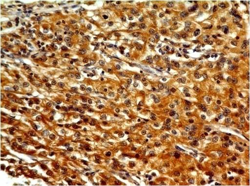 TLR7 / CD287 Antibody - Fig-3: Immunohistochemical analysis of TLR7 in Renal Cell Carcinoma using TLR7 antibody at 5 µg/ml.