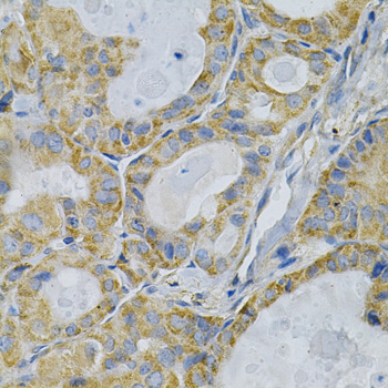 TLR7 / CD287 Antibody - Immunohistochemistry of formalin-fixed paraffin-embedded (FFPE) human thyroid cancer using TLR7 antibody at dilution of 1:100 (40x magnification).