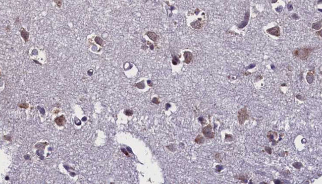 TLR7 / CD287 Antibody - 1:100 staining human brain carcinoma tissue by IHC-P. The sample was formaldehyde fixed and a heat mediated antigen retrieval step in citrate buffer was performed. The sample was then blocked and incubated with the antibody for 1.5 hours at 22°C. An HRP conjugated goat anti-rabbit antibody was used as the secondary.