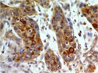 TLR8 Antibody - Fig-2: Immunohistochemical analysis of TLR8 in small cell carcinoma of esophagus using TLR8 antibody at 5 µg/ml.