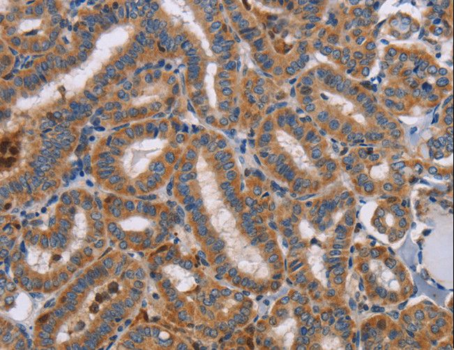 TLR8 Antibody - Immunohistochemistry of paraffin-embedded Human colon cancer using TLR8 Polyclonal Antibody at dilution of 1:40.