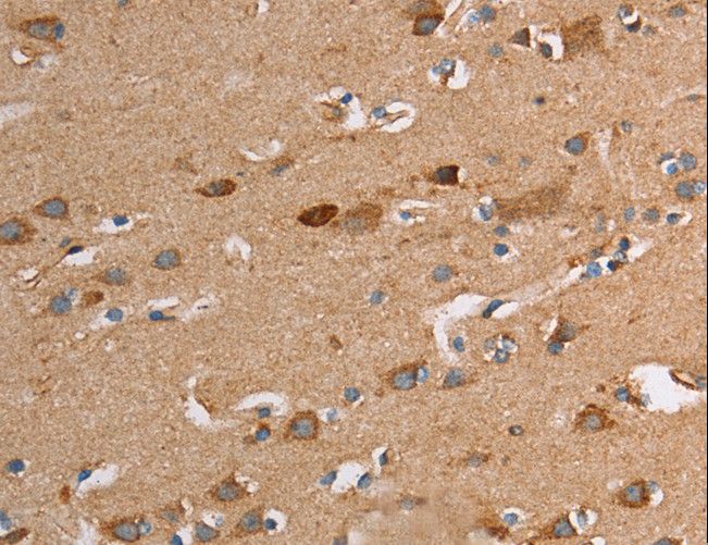 TLR8 Antibody - Immunohistochemistry of paraffin-embedded Human liver cancer using TLR8 Polyclonal Antibody at dilution of 1:30.