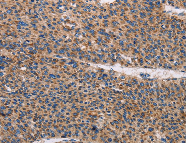 TLR8 Antibody - Immunohistochemistry of paraffin-embedded Human liver cancer using TLR8 Polyclonal Antibody at dilution of 1:30.