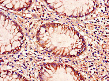 TLR9 Antibody - Immunohistochemistry of paraffin-embedded human colon cancer using TLR9 Antibody at dilution of 1:100