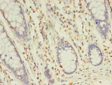TLT2 / TREML2 Antibody - Immunohistochemistry of paraffin-embedded human colon cancer using antibody at dilution of 1:100.