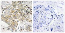 TM4SF1 Antibody - Immunohistochemistry analysis of paraffin-embedded human breast carcinoma tissue, using T4S1 Antibody. The picture on the right is blocked with the synthesized peptide.