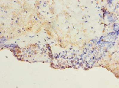 TM4SF1 Antibody - Immunohistochemistry of paraffin-embedded human breast cancer using antibody at dilution of 1:100.