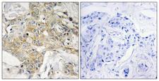 TM4SF1 Antibody - Peptide - + Immunohistochemistry analysis of paraffin-embedded human breast carcinoma tissue, using T4S1 antibody.