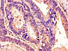 TM4SF20 Antibody - Immunohistochemistry of paraffin-embedded human colon cancer using TM4SF20 Antibody at dilution of 1:100
