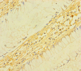 TM4SF5 Antibody - Immunohistochemistry of paraffin-embedded human colon cancer using TM4SF5 Antibody at dilution of 1:100