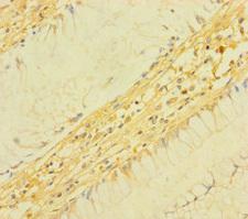 TM4SF5 Antibody - Immunohistochemistry of paraffin-embedded human colon cancer using TM4SF5 Antibody at dilution of 1:100